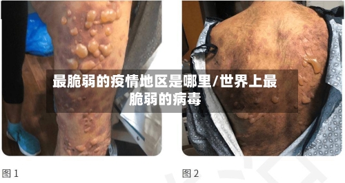 最脆弱的疫情地区是哪里/世界上最脆弱的病毒-第3张图片